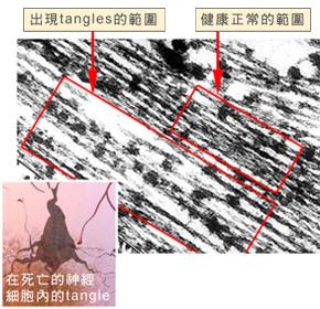 關於神經細胞纏結(Tangles)